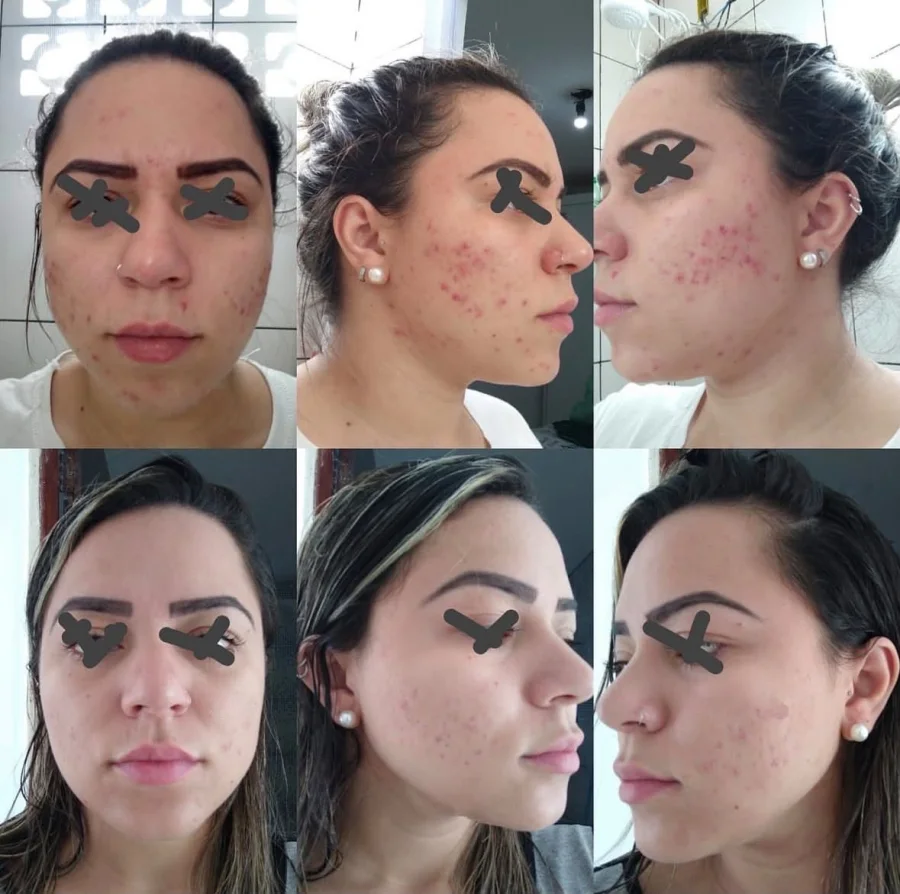 Comparação da evolução de tratamento para acne em três ângulos